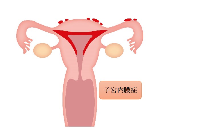 子宮 内 膜 増殖 症 ブログ